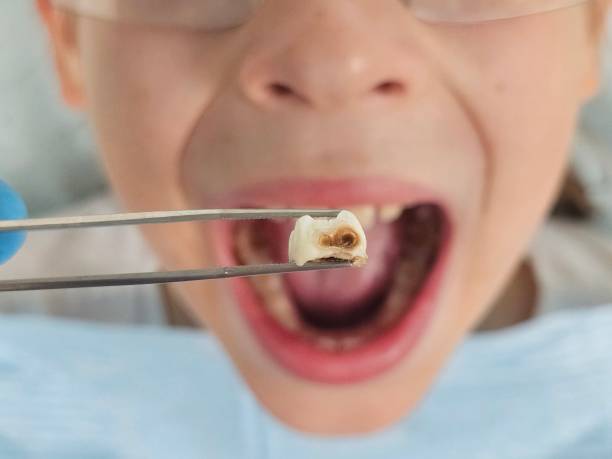 Best Emergency Treatment for Dental Infections or Abscesses in The Colony, TX